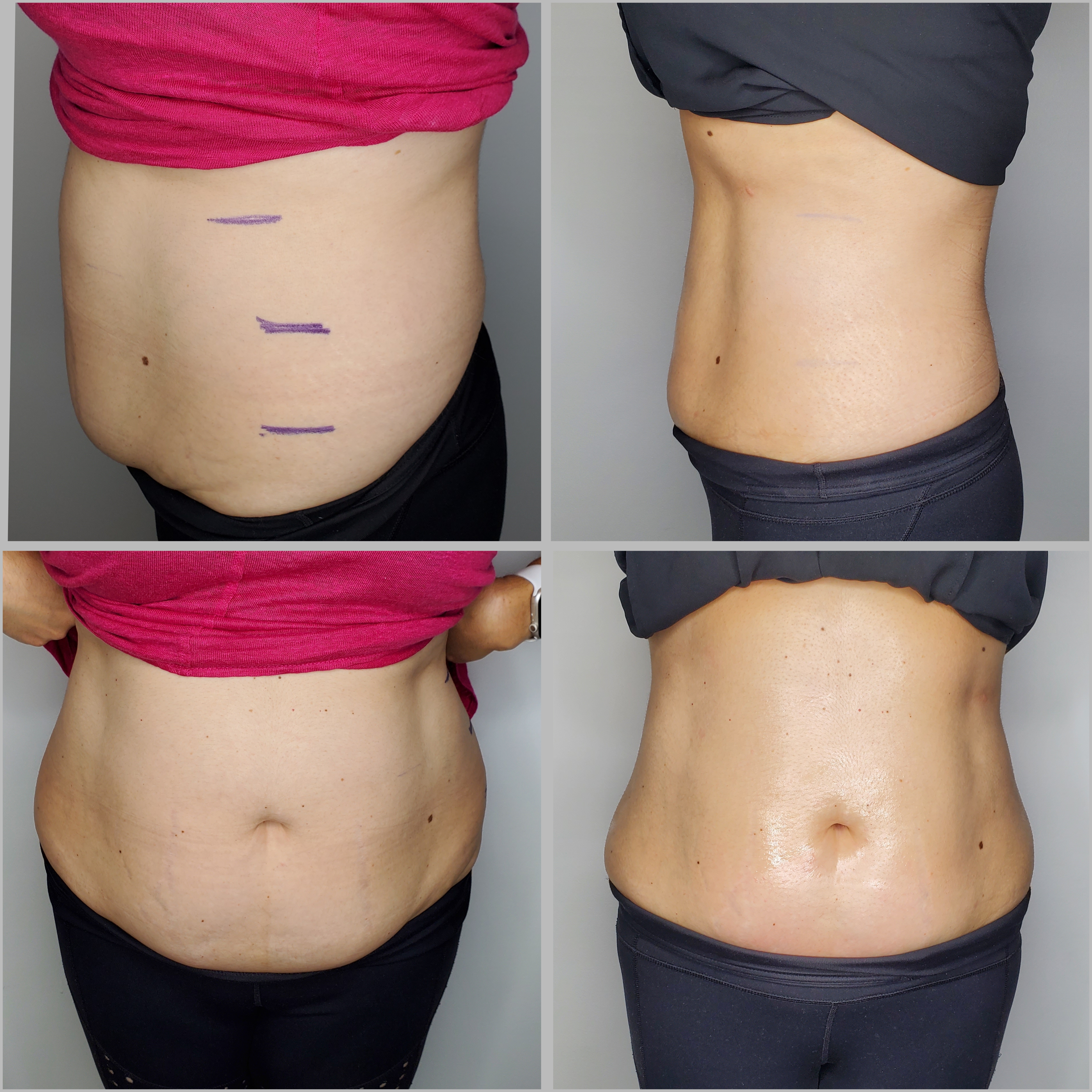 Non-Invasive Body Sculpting
