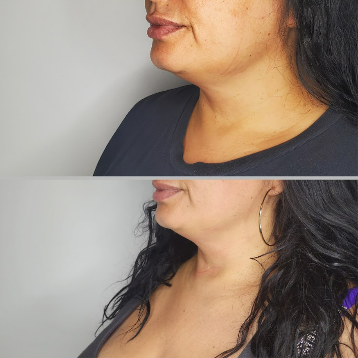 Body Sculpting Results