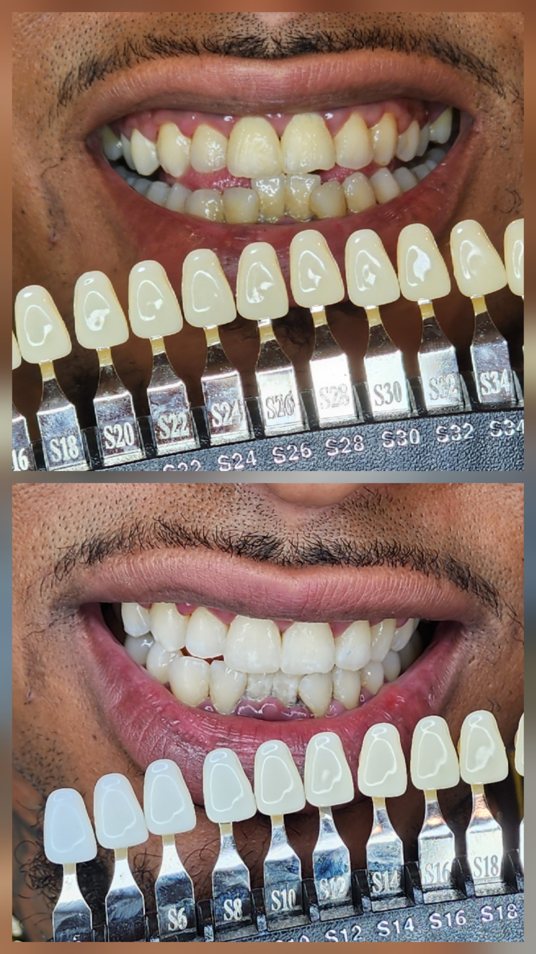 Teeth Whitening