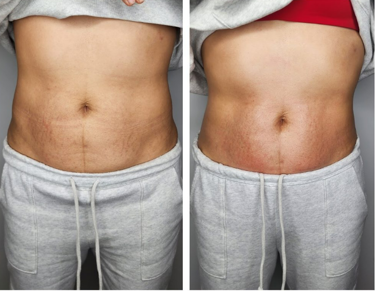 Lymphatic Drainage Massage