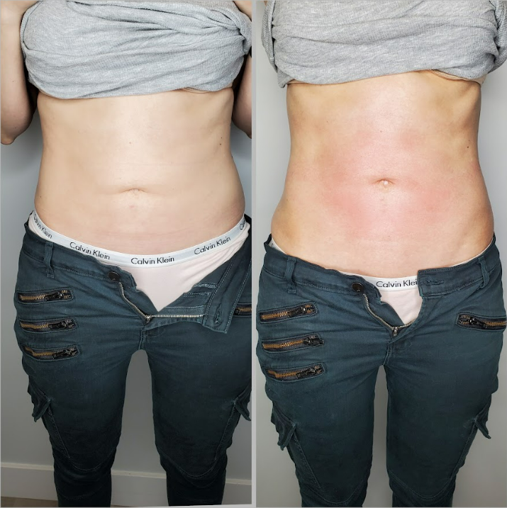 Lymphatic Drainage Results