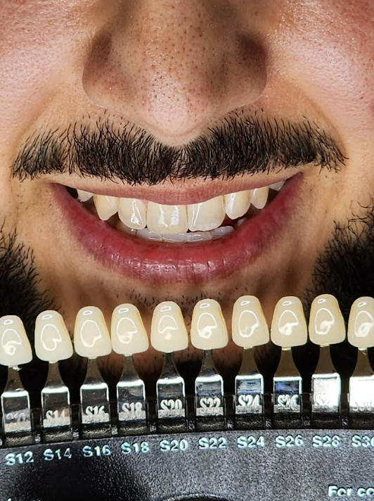 Teeth Whitening Results